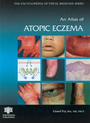 An Atlas of Atopic Eczema 1st Edition,1842142364,9781842142363