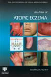 An Atlas of Atopic Eczema 1st Edition,1842142364,9781842142363