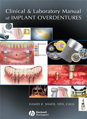 Clinical and Laboratory Manual of Implant Overdentures 1st Edition,0813808812,9780813808819