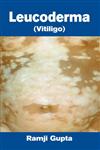 Leucoderma (Vitiligo) Diseases of White Patches 1st Edition,812690805X,9788126908059