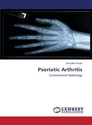 Psoriatic Arthritis,3659431362,9783659431364